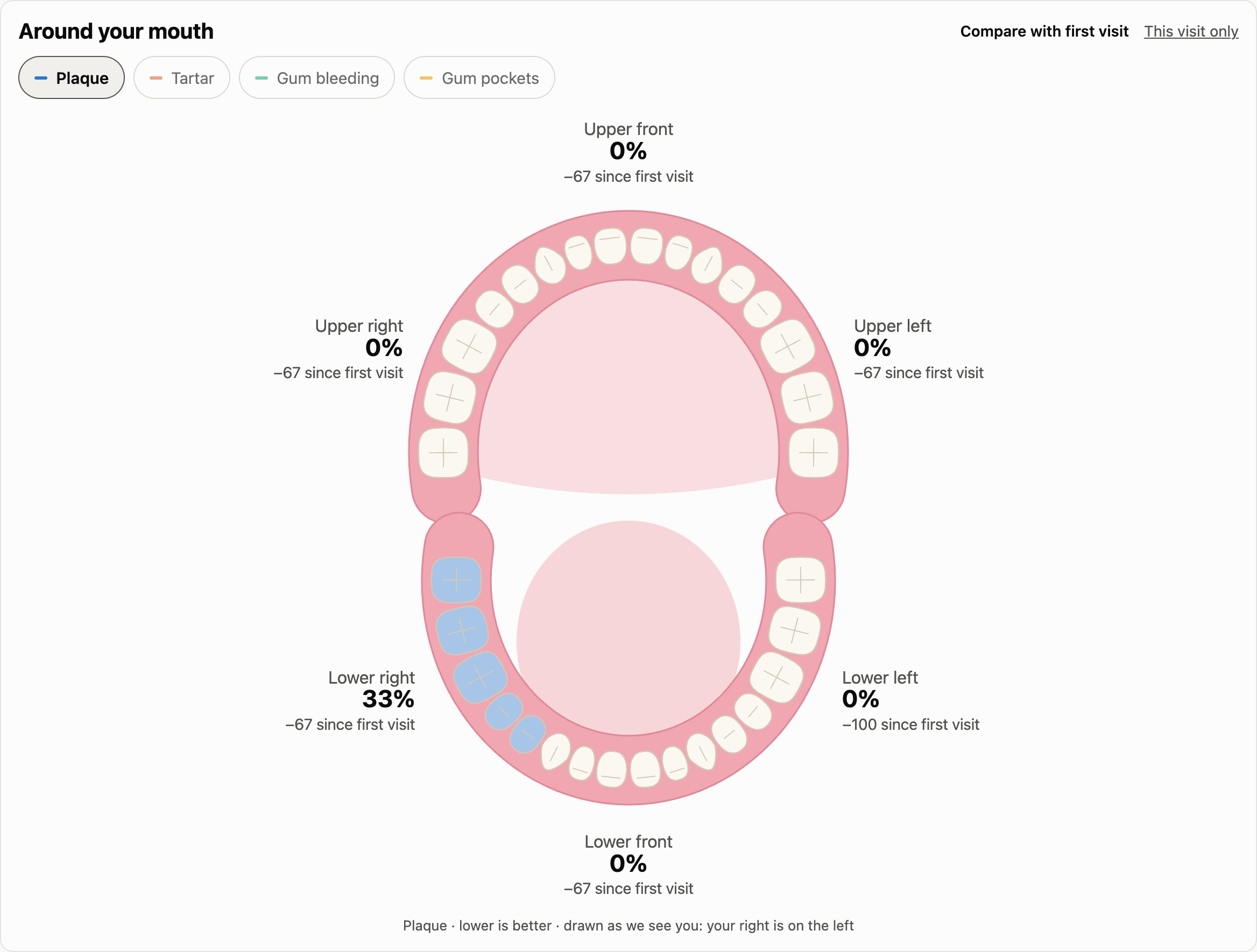 Illustrated mouth with all 32 teeth; the lower back teeth are tinted where plaque was found, with a percentage for each area